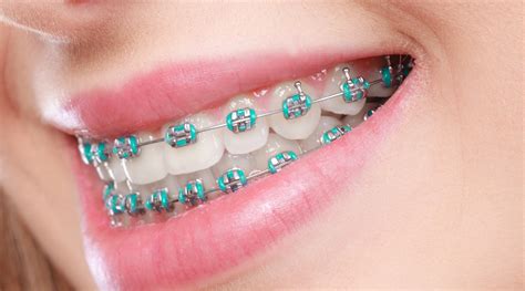 metal brackets dental|pictures of traditional steel braces.